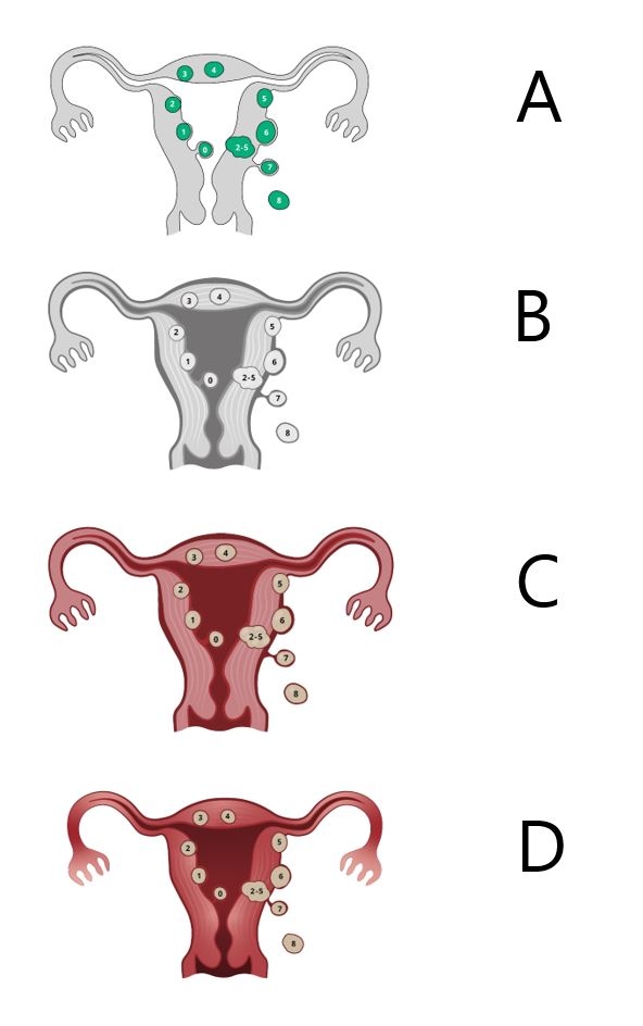 Uterusfibromer